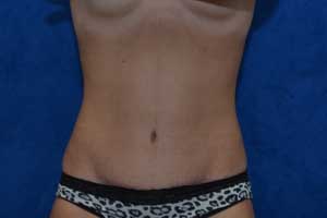 Tummy-Tuck-Case-5164 | After Tummy Tuck