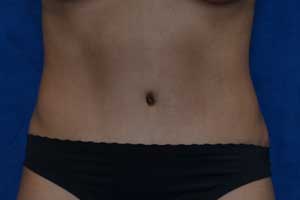 Tummy-Tuck-Case-5176 | After Tummy Tuck