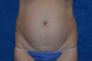 Tummy-Tuck-Case-5188 | Before Tummy Tuck