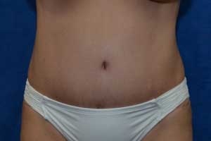 Tummy-Tuck-Case-5188 | After Tummy Tuck