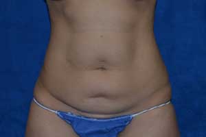 Tummy-Tuck-Case-5200 | Before Tummy Tuck