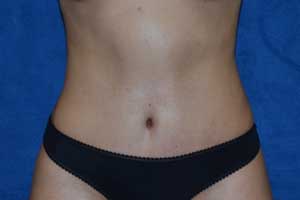 Tummy-Tuck-Case-5200 | After Tummy Tuck