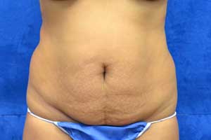 Tummy-Tuck-Case-5212 | Before Tummy Tuck