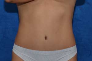 Tummy-Tuck-Case-5212 | After Tummy Tuck