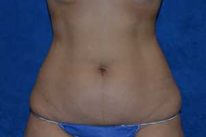 Tummy-Tuck-Case-5248 | Before Tummy Tuck