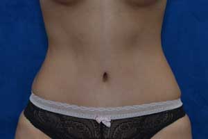 Tummy-Tuck-Case-5248 | After Tummy Tuck