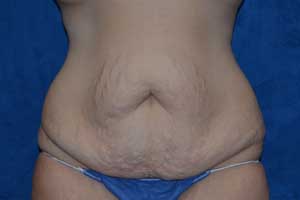 Tummy-Tuck-Case-5260 | Before Tummy Tuck