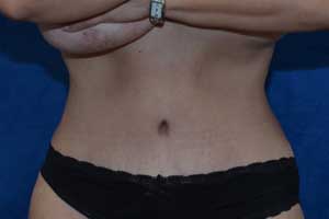 Tummy-Tuck-Case-5260 | After Tummy Tuck