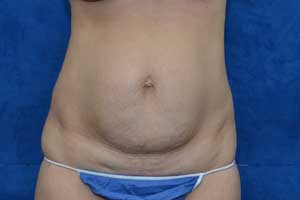 Tummy-Tuck-Case-5272 | Before Tummy Tuck