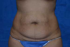 Tummy-Tuck-Case-5344 | Before Tummy Tuck