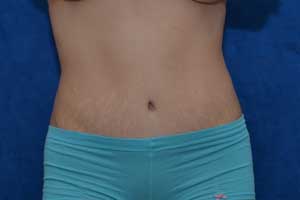 Tummy-Tuck-Case-5356 | After Tummy Tuck