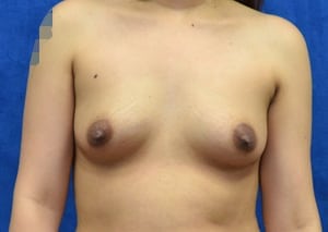 Breast-Augmentation-Case-5380 | Before Breast Augmentation