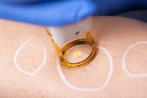 Facial Spider Vein Treatmetn