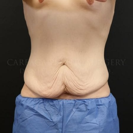 Massive-Weight-Loss-Case-5825 | Before Massive Weight Loss