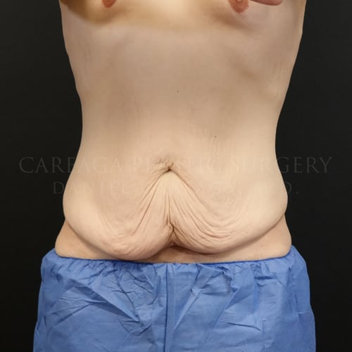 Massive Weight Loss Case 5825 before