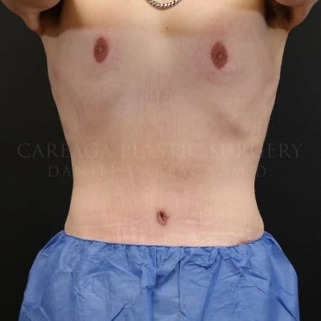 Massive-Weight-Loss-Case-5825 | After Massive Weight Loss