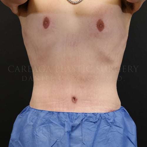 Massive Weight Loss Case 5825 after