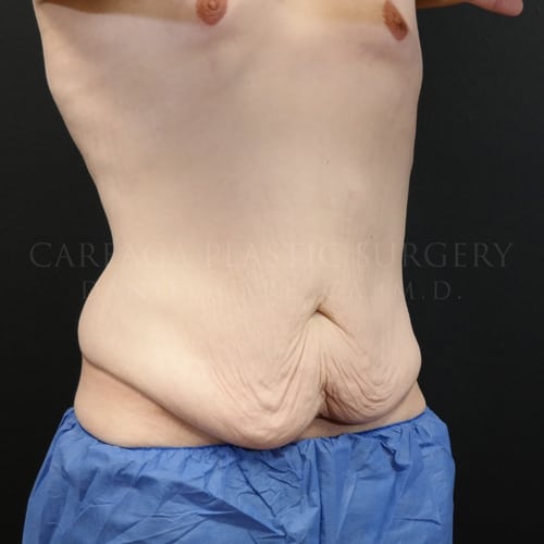 Massive Weight Loss Case 5825 before, view 2