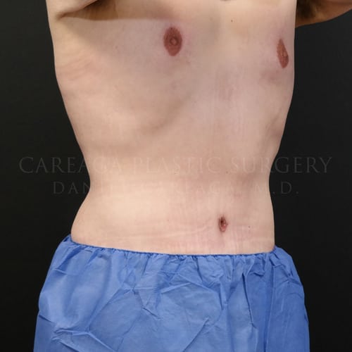 Massive Weight Loss Case 5825 after, view 2
