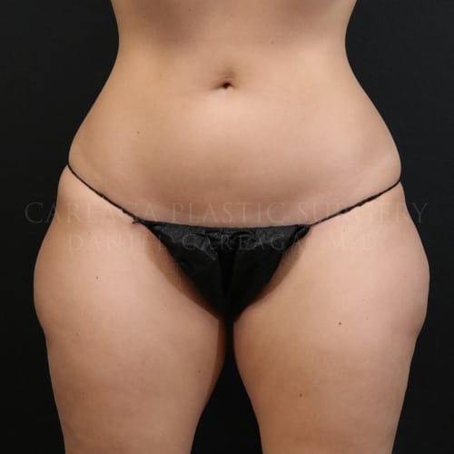 Liposuction Case 5835 before
