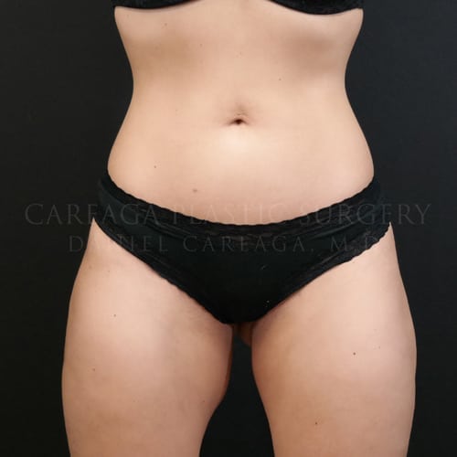 Liposuction Case 5835 after