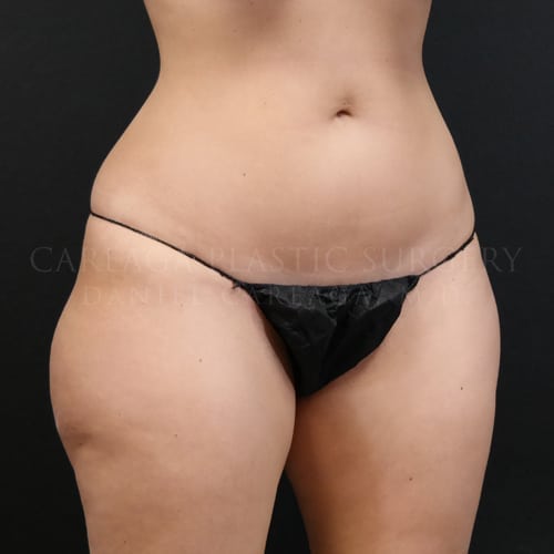 Liposuction Case 5835 before, view 2