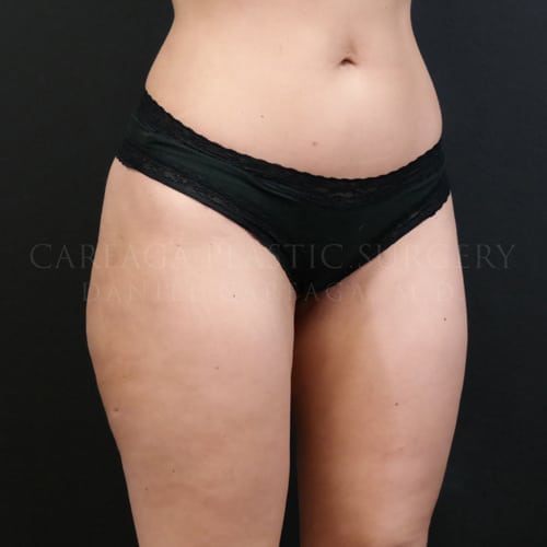 Liposuction Case 5835 after, view 2