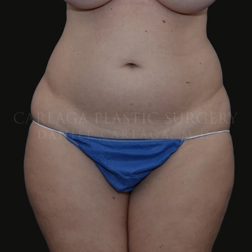 Liposuction Case 5858 before