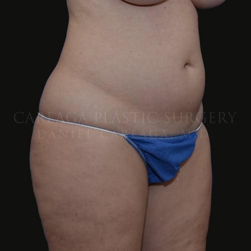 Liposuction Case 5858 before, view 2
