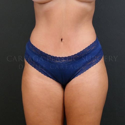 Tummy-Tuck-Case-5860 | After Tummy Tuck