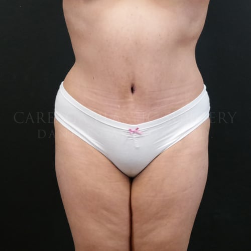 Tummy Tuck Case 5967 after