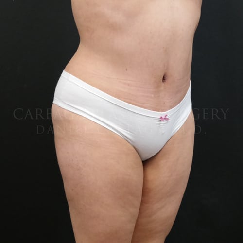 Tummy Tuck Case 5967 after, view 2