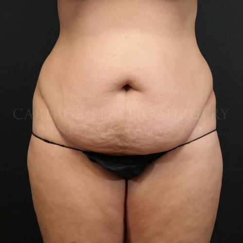 Tummy Tuck Case 5973 before