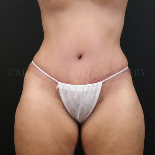 Tummy Tuck Case 5973 after