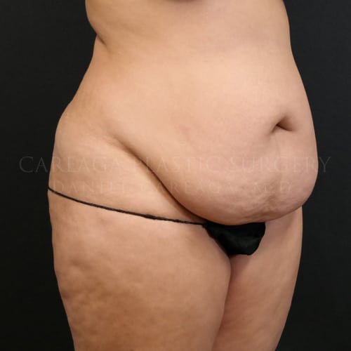 Tummy Tuck Case 5973 before, view 2