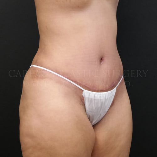 Tummy Tuck Case 5973 after, view 2