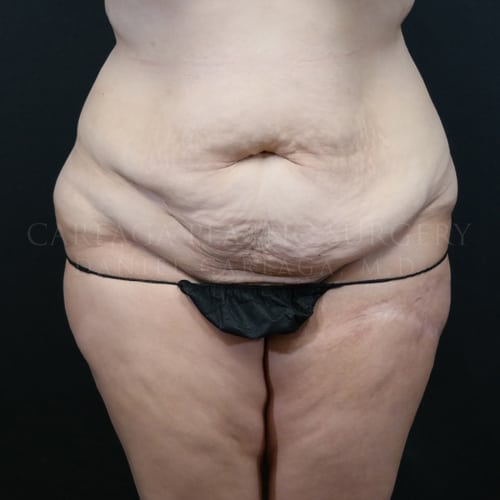 Tummy Tuck Case 5979 before