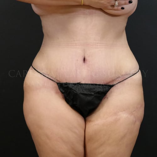 Tummy Tuck Case 5979 after