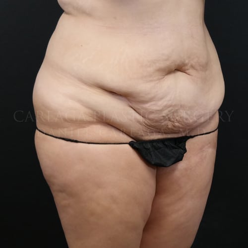 Tummy Tuck Case 5979 before, view 2
