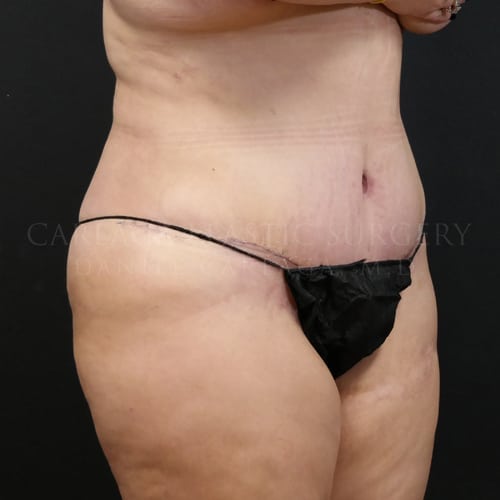 Tummy Tuck Case 5979 after, view 2