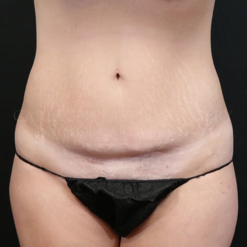 Tummy Tuck  Case 5985 before