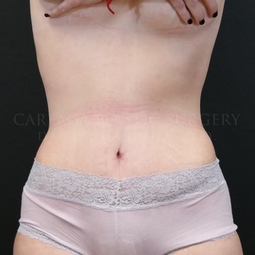 Tummy Tuck Case 5985 after