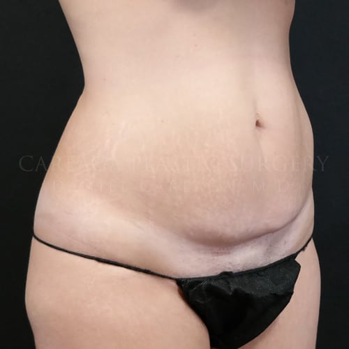 Tummy Tuck  Case 5985 before, view 2