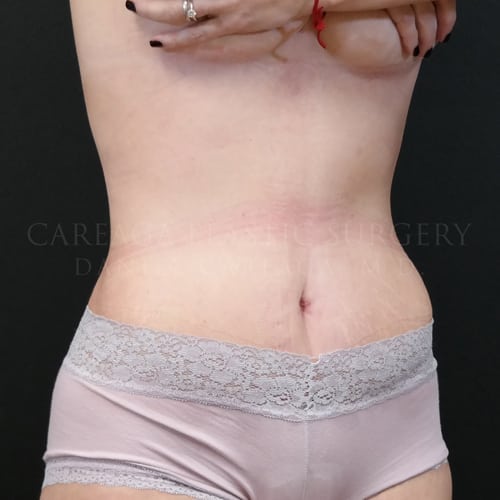 Tummy Tuck  Case 5985 after, view 2