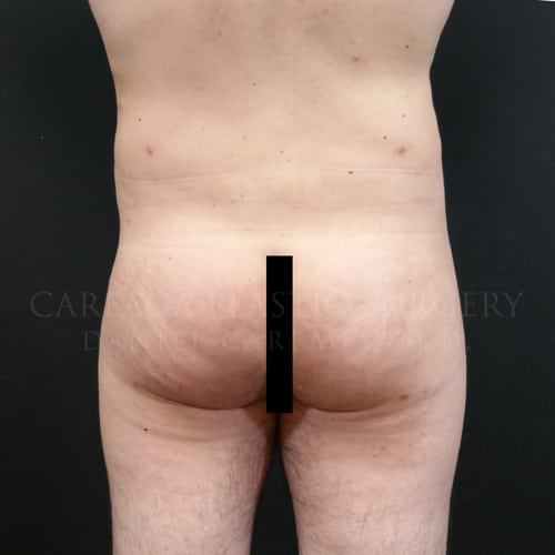 Brazilian Butt Lift Case 5955 before