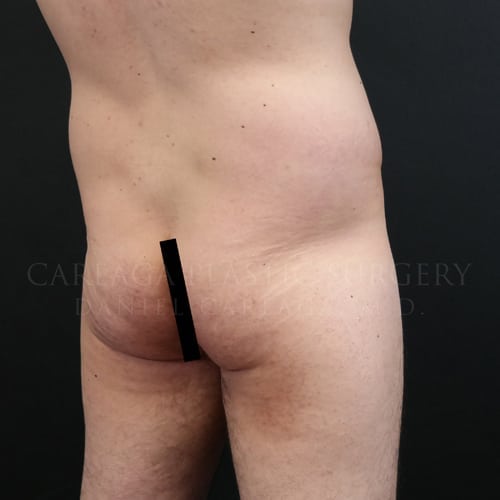 Brazilian Butt Lift Case 5955 before, view 2