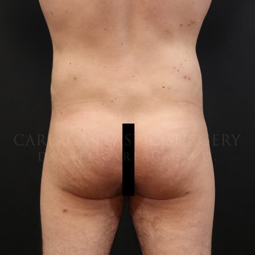Brazilian Butt Lift Case 5955 after