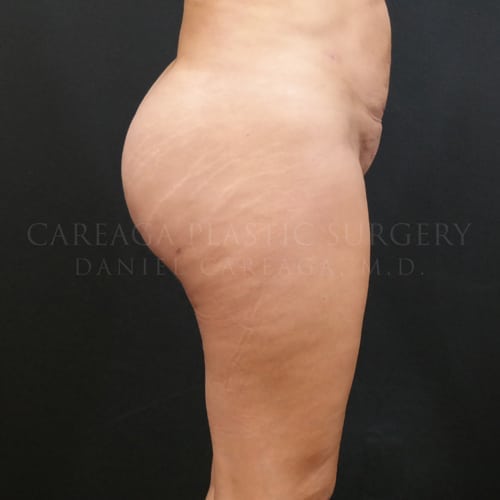 Brazilian Butt Lift Case 5961 after, view 2
