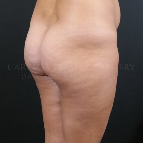 Brazilian Butt Lift Case 5961 before