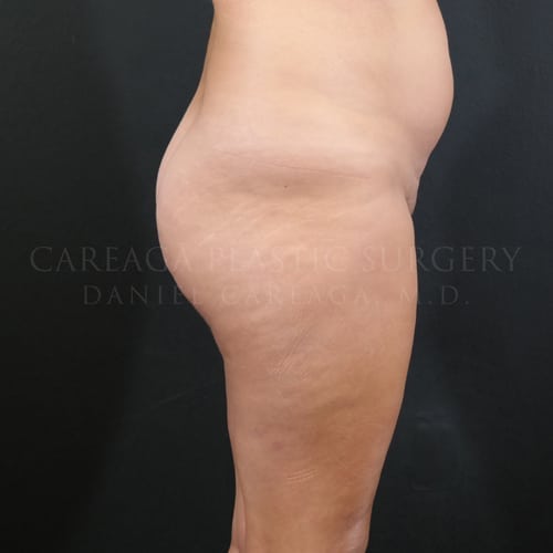 Brazilian Butt Lift Case 5961 before, view 2